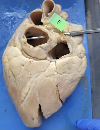 <p>pulmonary vein </p>