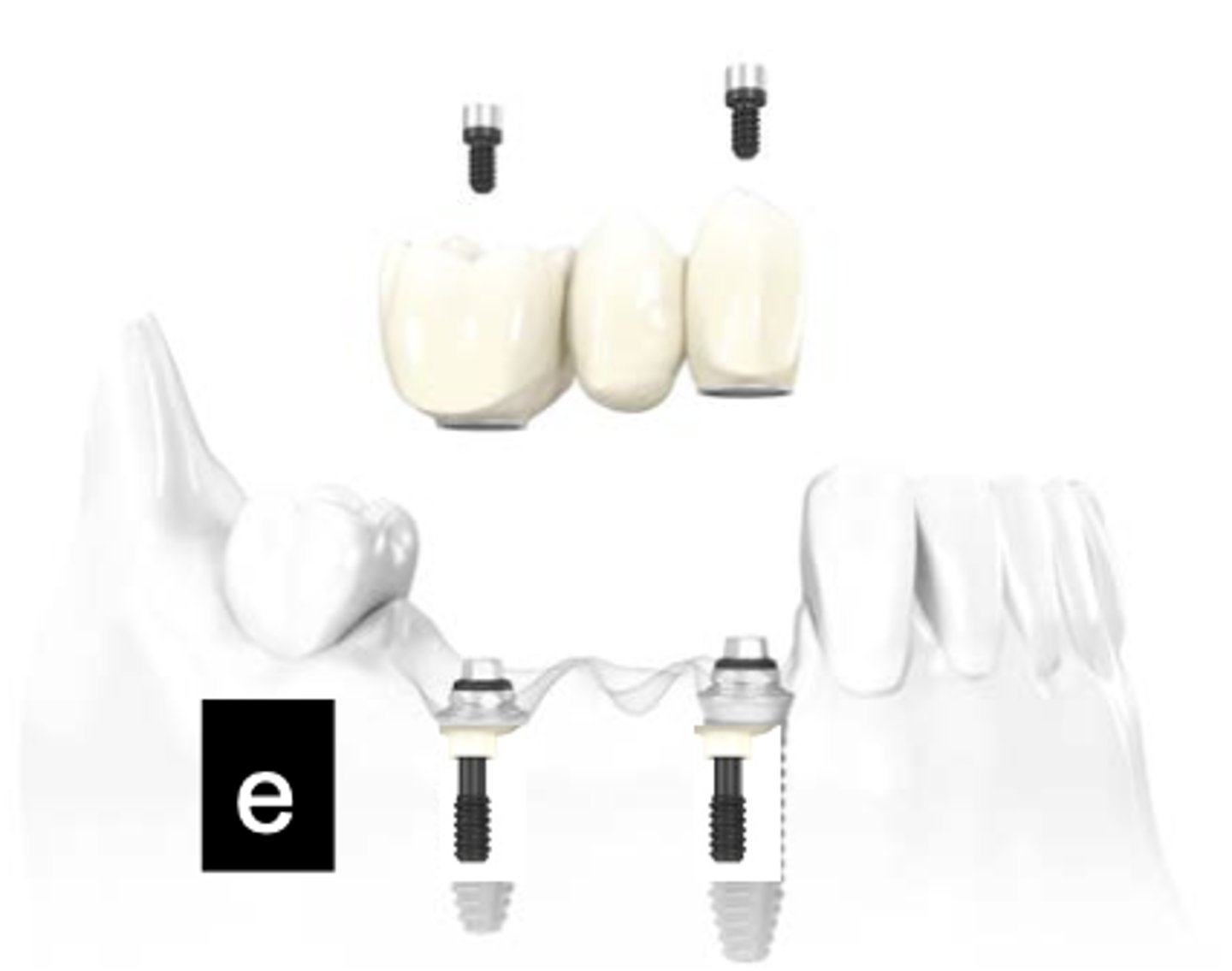 <p>What type of implant does this show?</p>