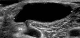 <p>If the sonographer is scanning behind the knee/popliteal area, what pathology is seen here? </p>