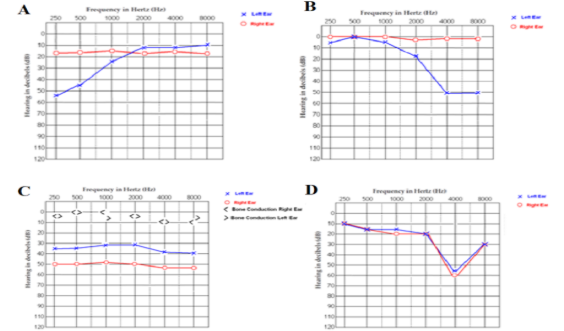 <p>B. since the left ear is the one affected it should go lower</p>
