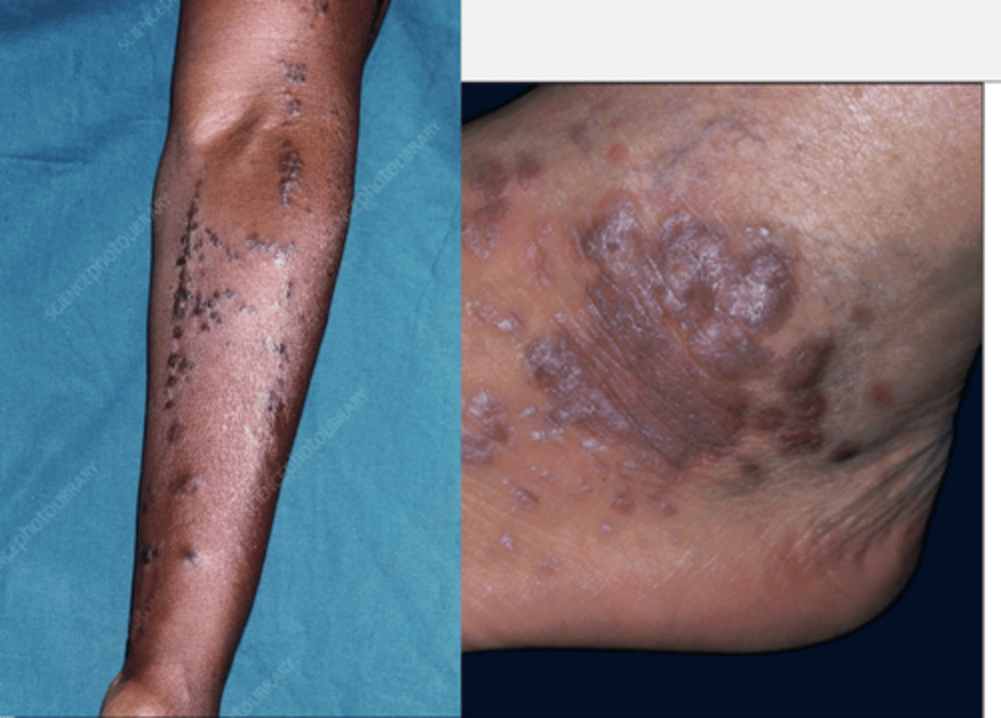 <p>chronic inflammatory disorder mediated by T cells, manifesting as</p><p>- pruritic,</p><p>- polygonal,</p><p>- planar,</p><p>- purple</p><p>- papules or</p><p>- plaques</p><p>( known as the 6 P's.)</p>