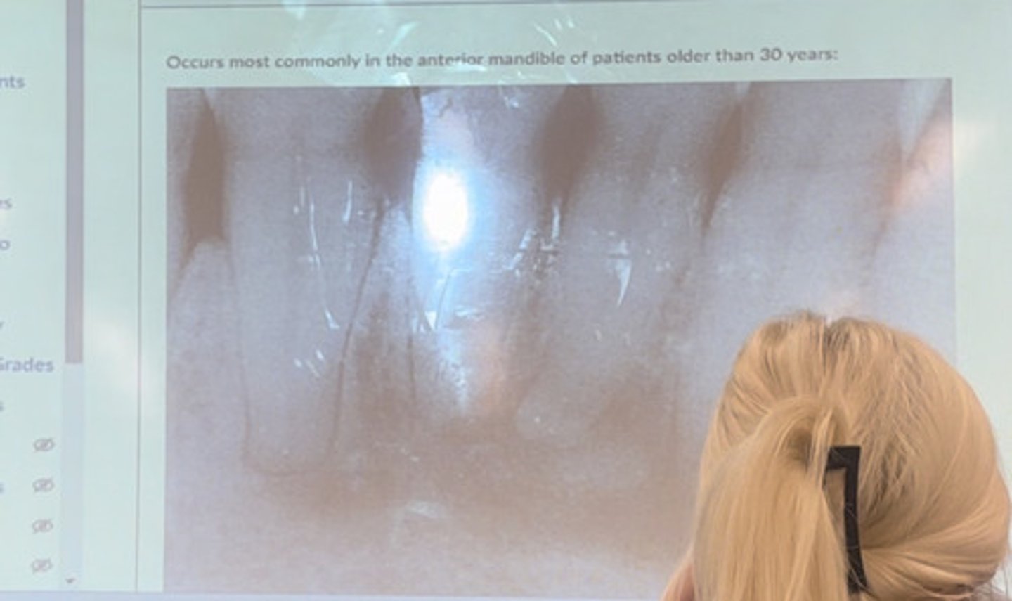 <p>Occurs most commonly in the anterior mandible of patients older than 30 years</p>