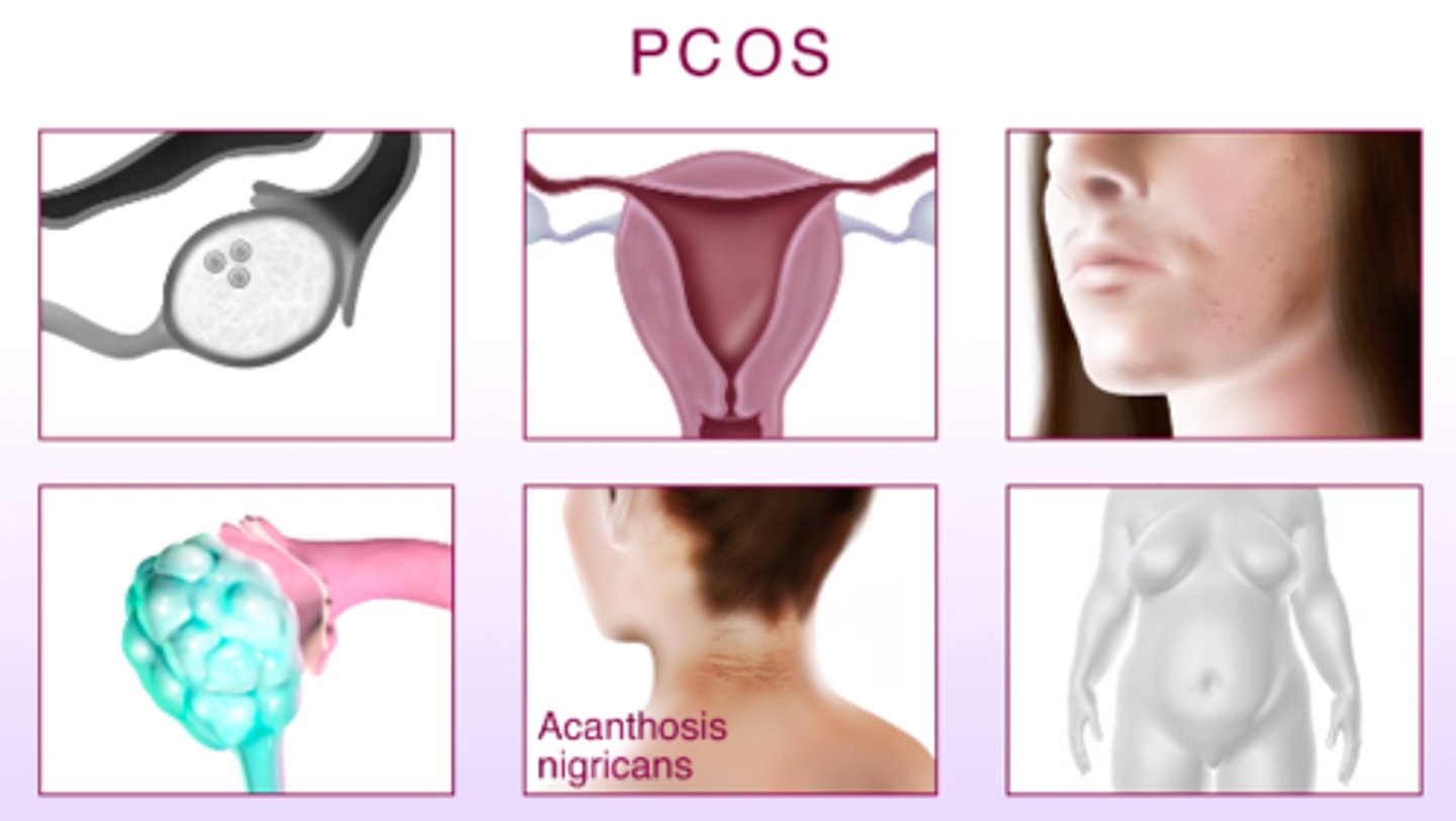 <p>irregular menstrual cycles, elevated hormone levels, multiple cysts on ovaries</p>