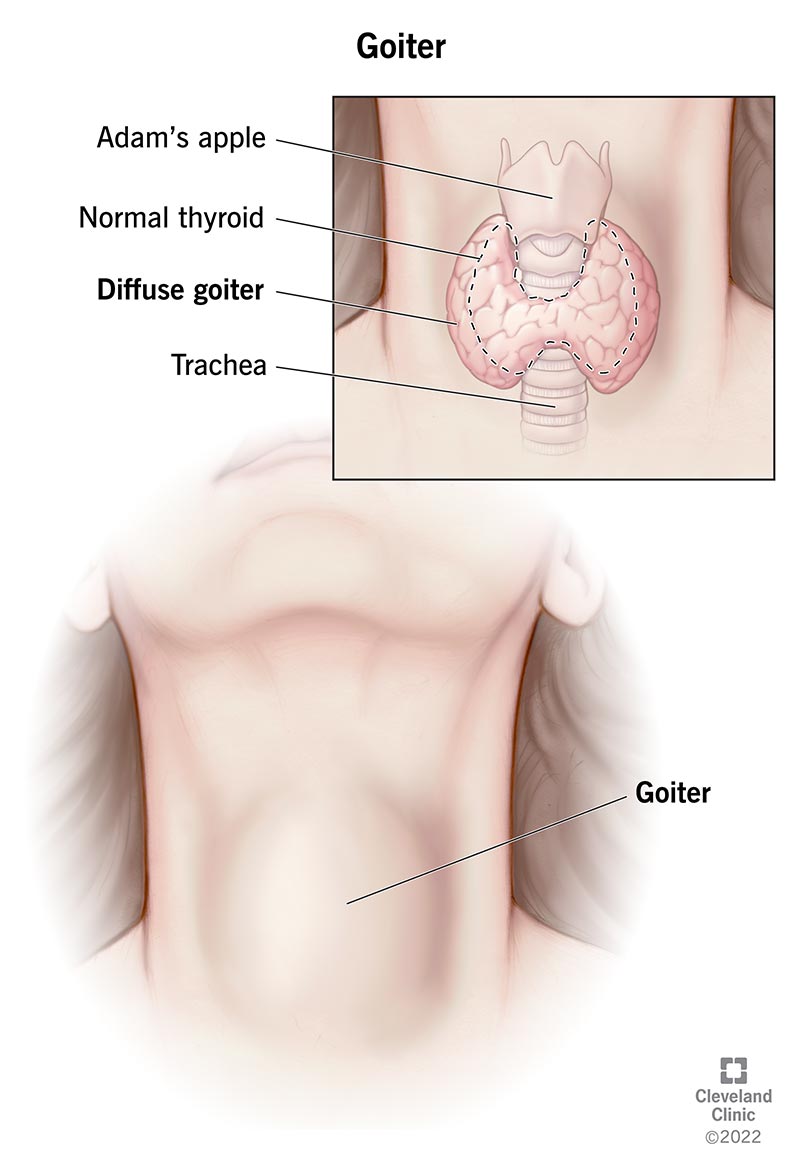 <p>Enlarged thyroid gland; a large lump on the neck due to iodine insufficiency</p>