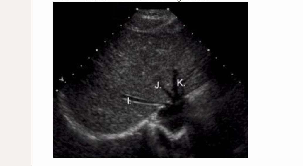 <p>letter I is which vessel</p><p>.</p><p>a) left portal vein</p><p>b) right hepatic vein</p><p>c) middle hepatic vein</p><p>d) left hepatic vein</p>