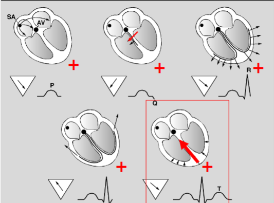 <p>The SA node: Towards AV node - towards electrode - positive deflection (p wave)</p><p>Ventral septum: Away from electrode - small negative deflection (q wave)</p><p>Ventricle: Towards electrode - large positive deflection (r wave)</p><p>Ventricle last portion: Away from electrode - small negative deflection (s wave)</p><p>Repolarisation of heart: Away from electrode - positive deflection (t wave)</p>