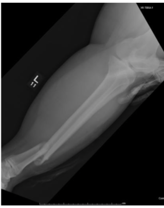 <p>What do we gotta do for tibial shaft fractures?</p>