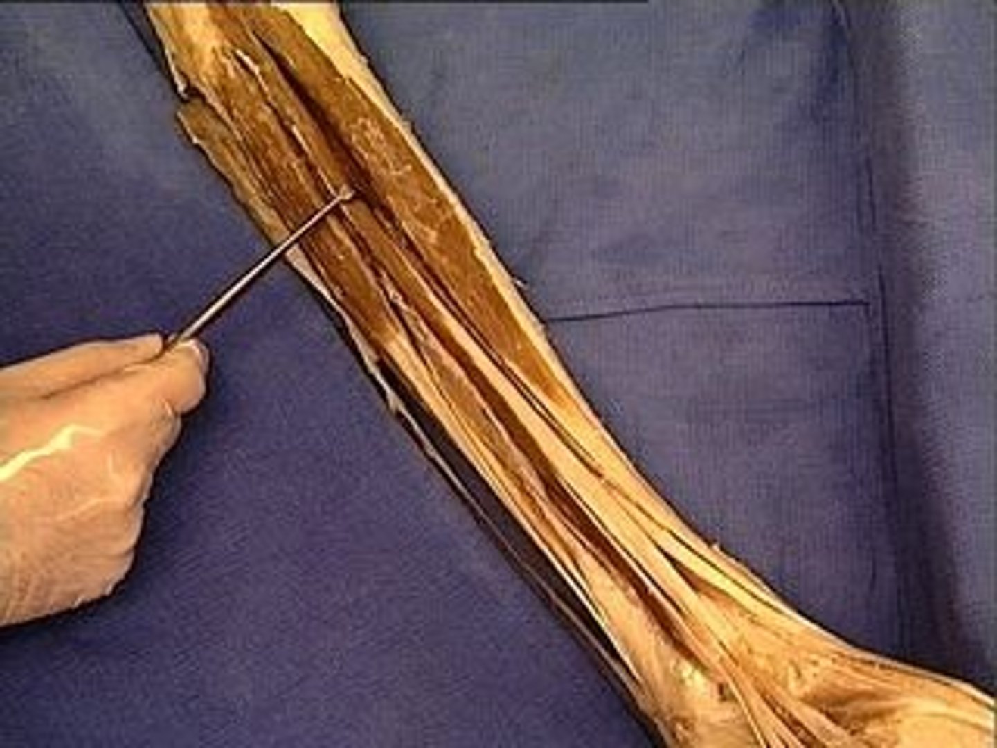 <p>Extends the lateral four toes; dorsiflexion of ankle and eversion of foot; Femur to Phalange</p>