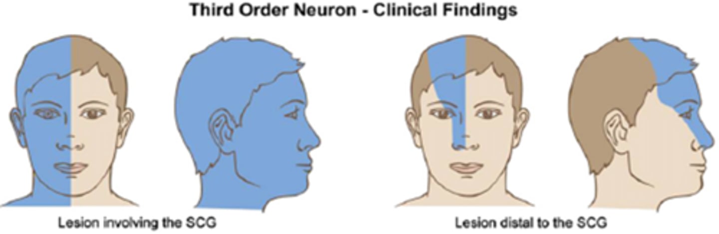 <p>ipsilateral anyhydrosis of the forehead only</p>