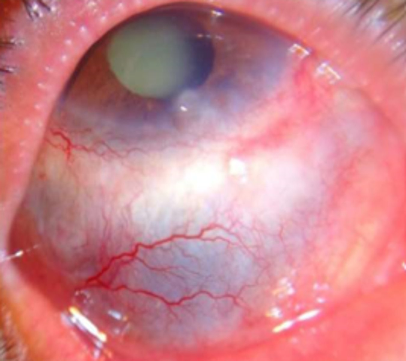 <p><u>Etio</u>: inflammatory &amp; autoimmune process involving the sclera</p><p><u>Risk Factors</u>: Rheumatoid arthritis, Wegener's Granulomatosis</p><p><u>S&amp;S</u>: painful, local tenderness, <strong>sclera edema,</strong> potentially blinding</p><p><u>Tx</u>: NSAIDS <strong><mark data-color="#deff00" style="background-color: #deff00; color: inherit">(indomethacin 25-75 mg PO TID)</mark></strong>, consider <strong>glucocorticoids (prednisone), </strong>emergent consult to ophtho, urgent consult to rheum</p>