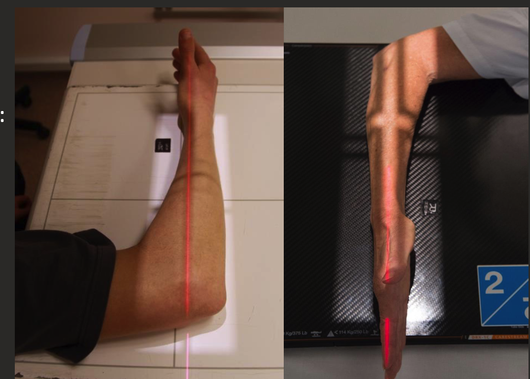 <ul><li><p>Forearm aligned parallel to long edge IR or diagonal.</p></li><li><p>Hand/Wrist and elbow in ‘true lateral’.</p><ul><li><p>Elbow flexed 90 degrees.</p></li><li><p>Distal radius and ulna superimposed.</p></li><li><p>Humeral epicondyles superimposed (raise wrist to help achieve this).</p></li></ul></li><li><p>Hand elbow and shoulder on same horizontal plane.</p></li><li><p>CR perpendicular to IR.</p></li><li><p>Collimate for both joints and 5-8cm of distal humerus.</p></li></ul><p></p>