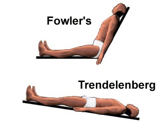 <p>Describe the <strong>Trendelenberg</strong> patient position.</p>
