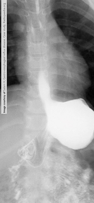 <p>What is the standard imaging study for GERD?</p>