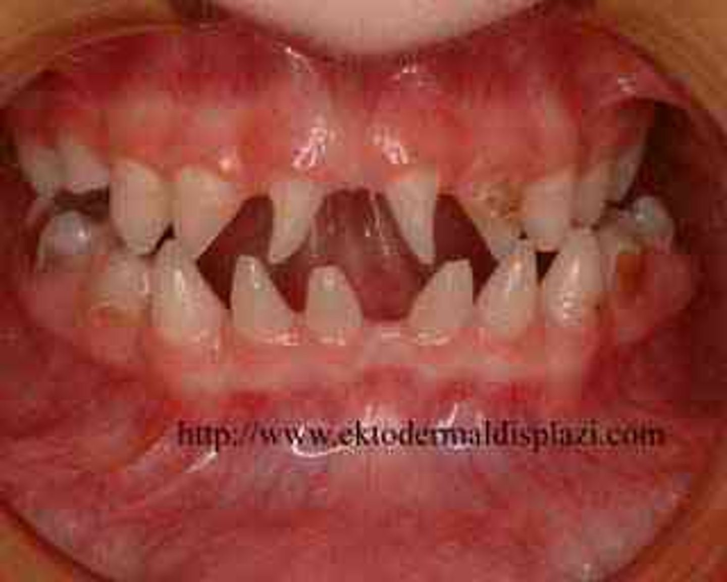 <p>Abnormal development of teeth</p>