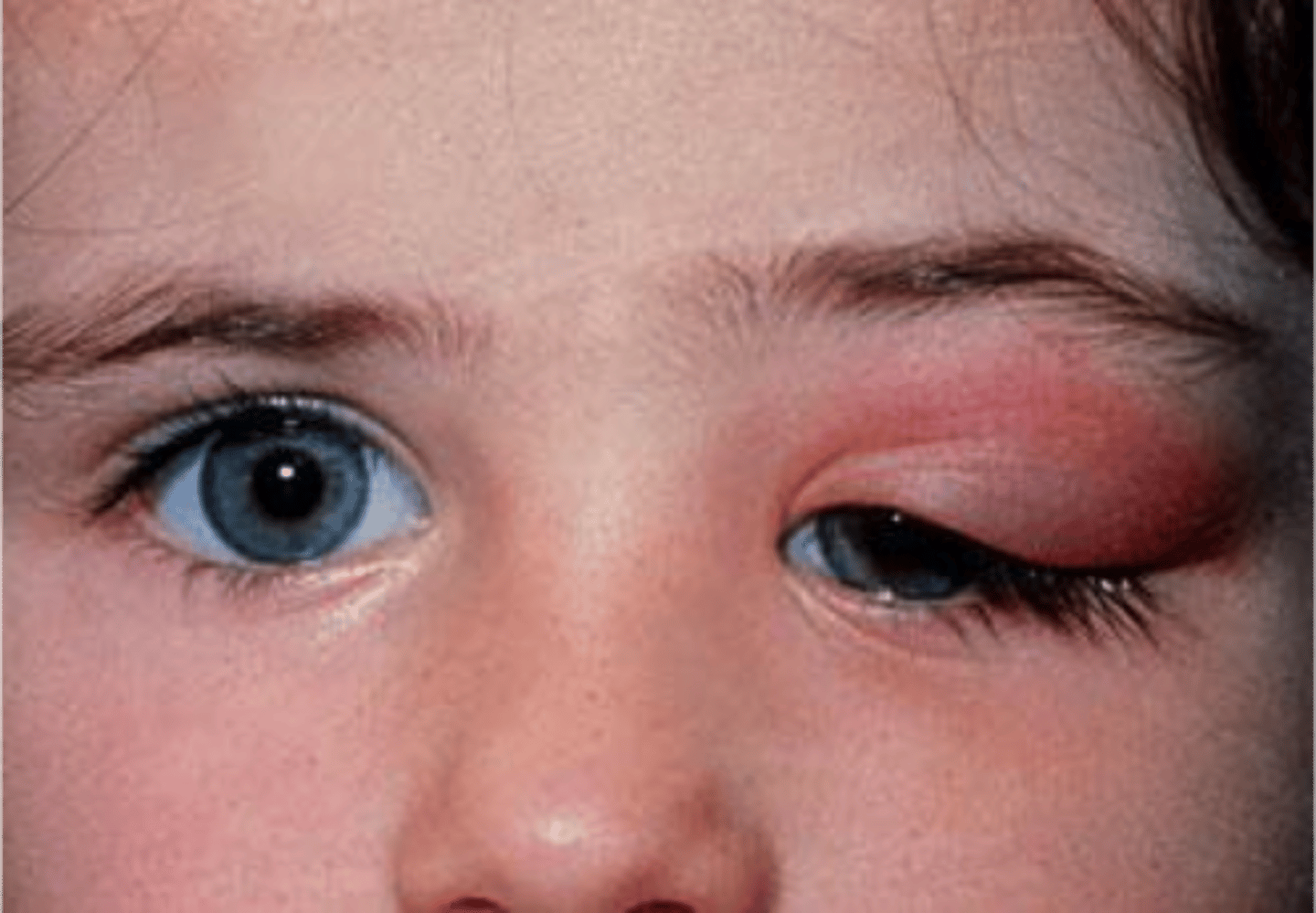 <p>Dacryoadenitis is inflammation of lacrimal (tear-producing) glands usually caused by bacteria or a virus that initiates the inflammation (supratemporal)</p>