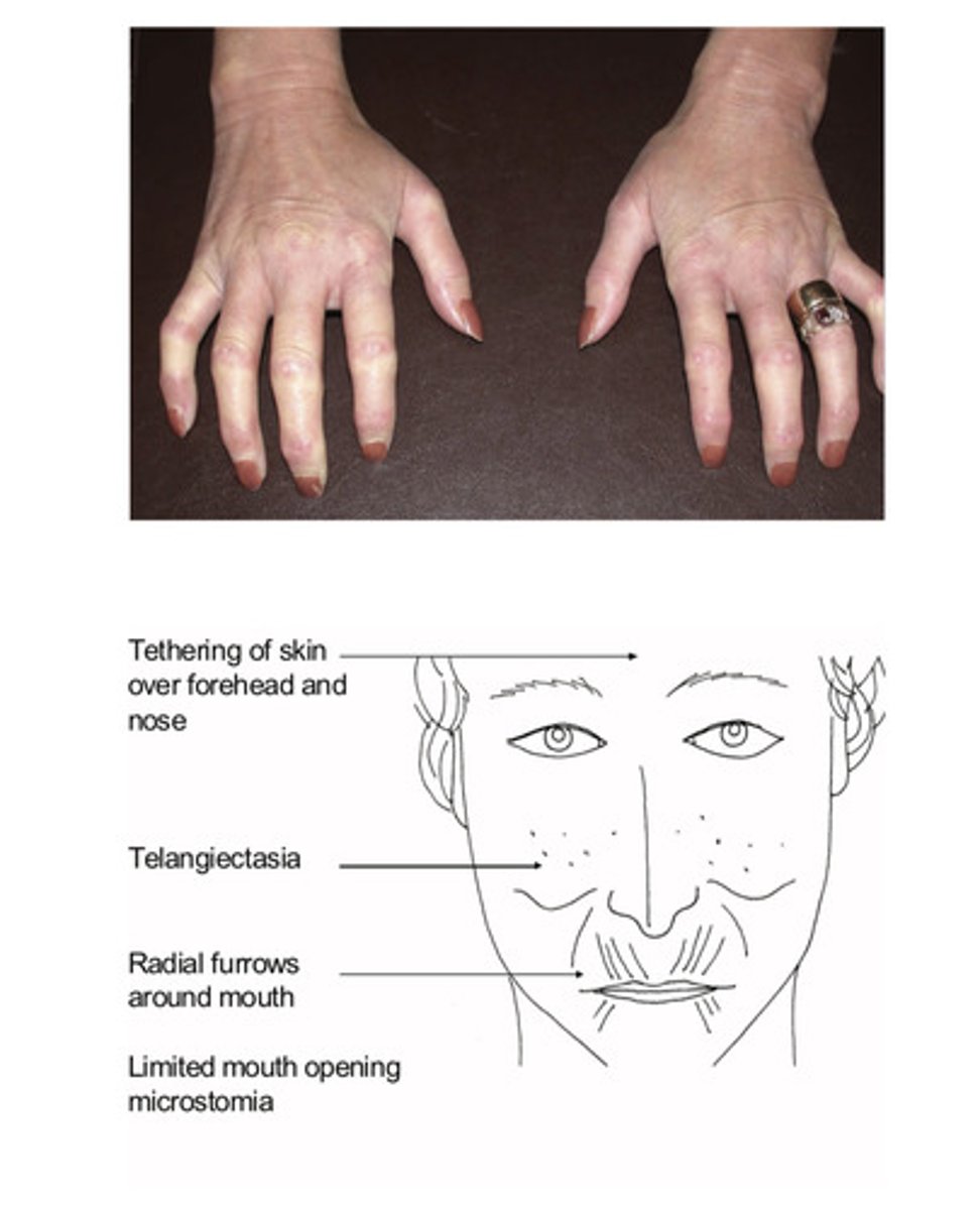 <p>Hands:</p><p>Sclerodactylty</p><p>Telangiectasia</p><p>Raynauds</p><p>Evidence ulceration (knuckles, finger tips)</p><p>Prayer test</p><p>Subcutaneous calcifications</p><p>Skin tethering:</p><p>Face , upper arms, chest (diffuse cutaneous scleroderma)</p><p>Telangiectasia</p><p>Mouth opening reduced; (microstomia)</p><p>Test with three finger test</p>