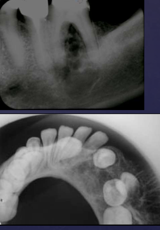 <ol><li><p>well defined, corticated or ill defined periphery possible</p></li><li><p>radiolucent</p></li><li><p>periosteal rxn (sunray-like appearance)</p></li><li><p>maybe multilocular</p></li><li><p>honeycomb pattern</p></li><li><p>displacement of teeth/root resorption</p></li></ol><p></p>
