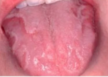 <p>diagnosis of this lesion that keeps changing location </p>