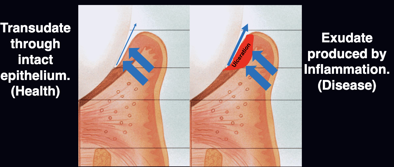 <p>transudate is through intact epithelium (healthy)<br>exudate produced by inflammation (disease)</p>