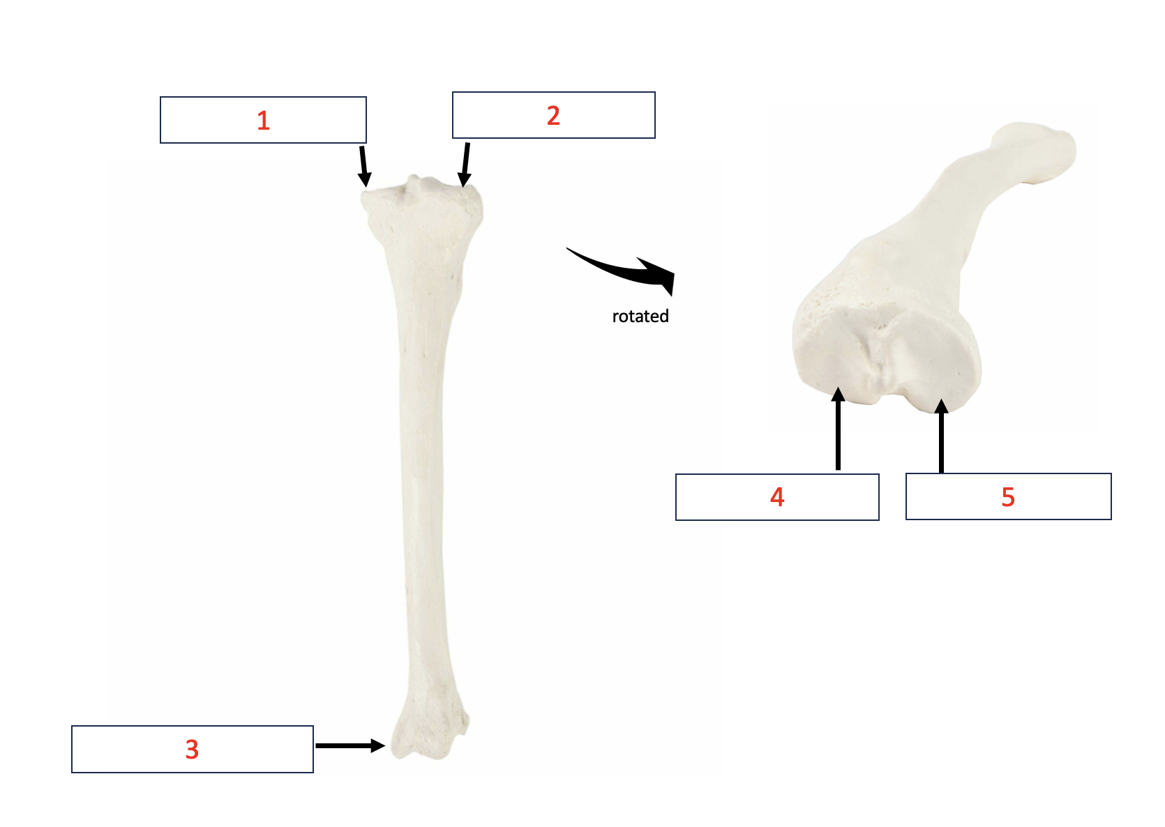 <p>Tibia - lateral condyle </p>