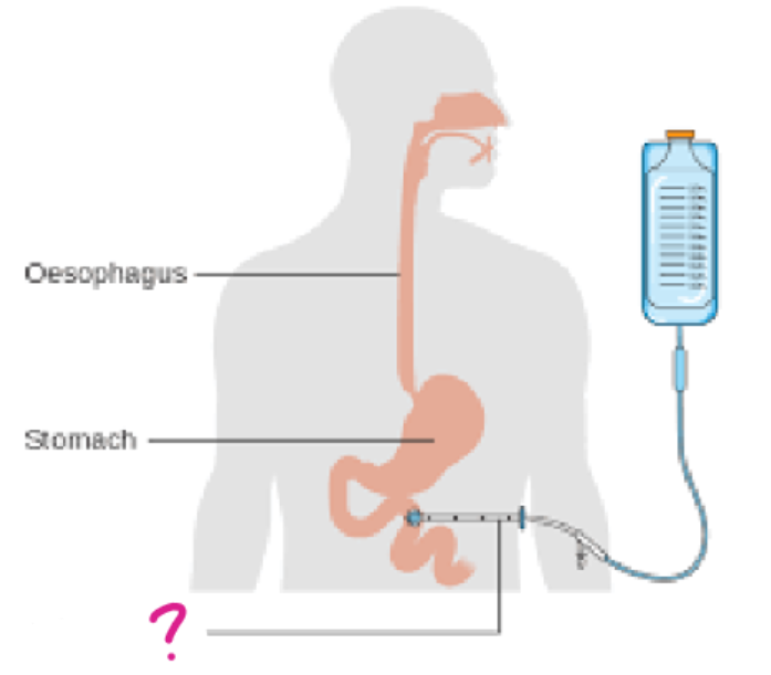 <p>a form of enteral administration in which: </p><ul><li><p>a tube is inserted through the abdomen into the jejunum <em>(located in the small intestine)</em></p></li><li><p>used to administer nutrition and medications</p></li></ul><p></p>