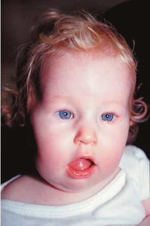 <p>Poor feeding in infancy, later develops hyperphagia / obesity, mild-moderate intellectual disability </p>