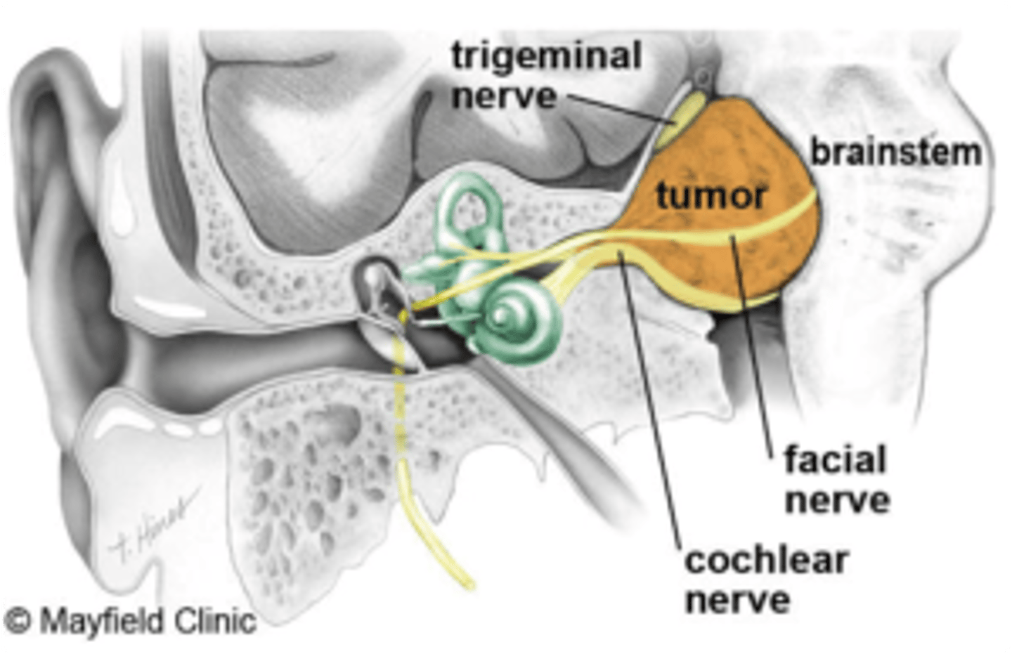 <p>Cochlear nerve involvement </p><p>- Unilateral sensorineural hearing loss (most common symptom)</p><p>- Tinnitus</p><p>Vestibular nerve involvement </p><p>- Dizziness </p><p>- Unsteady gait and disequilibrium</p><p>Later symptoms are caused by pressure of the tumour on adjacent structures of the cerebellopontine angle </p><p>Trigeminal nerve (CN V) involvement: paresthesia (numbness), hypoesthesia (decreased sensation), and/or unilateral facial pain, absent corneal reflex </p><p>Facial nerve (CN VII) involvement: peripheral, unilateral facial weakness that can progress to paralysis</p><p>Cerebellum: ataxia </p><p>Fourth ventricle: hydrocephalus </p>