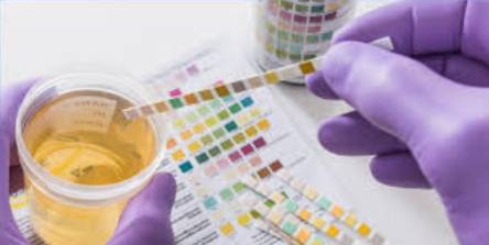 <p>Urinary glucose is testing glucose levels in urine. Healthy urine should have no glucose, but those suffering from hyperglycaemia, would have glucose in their urine, which is called glucosuria. While quick, easy and not invasive, not as accurate as other testing methods and can be affecyed by certain renal factors</p>