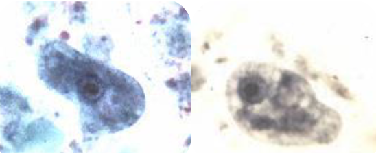 <ul><li><p><span>Large dense karyosome</span></p></li><li><p><span>Heavier chromatin (nuclear membrane) than Endolimax nana</span></p></li><li><p><span>"dirty" cytoplasm</span></p></li><li><p>12-15u</p></li></ul><p></p>