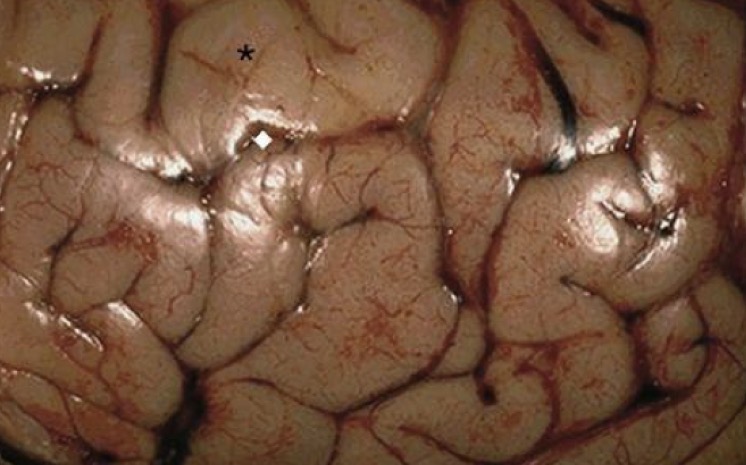 <p><span>1. Identify the condition. <br>2. Describe the morphology? <br>3. What is the possible life-threatening complication in such a condition? <br></span></p>