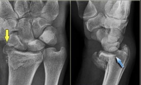 <p>what is this fracture? </p>