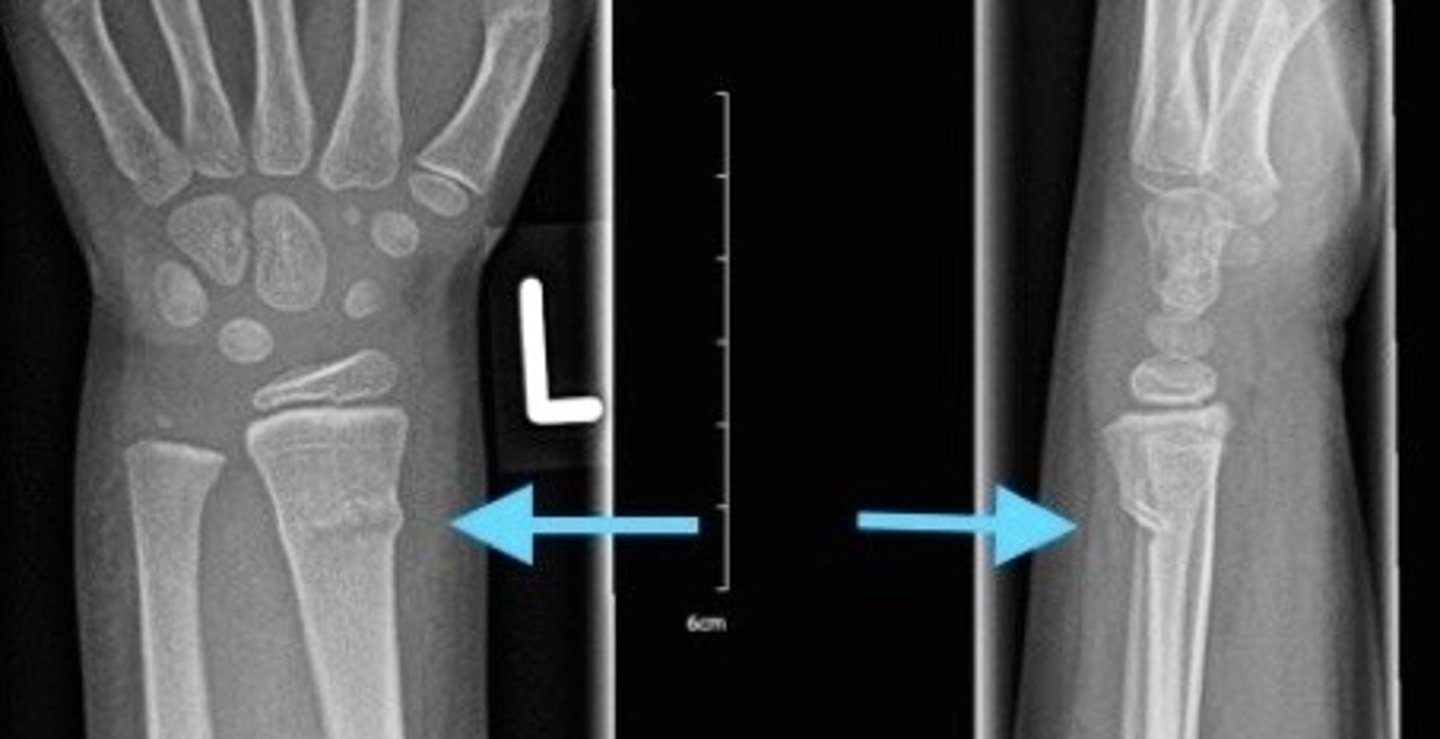 <p>What type of fracture is shown?</p>