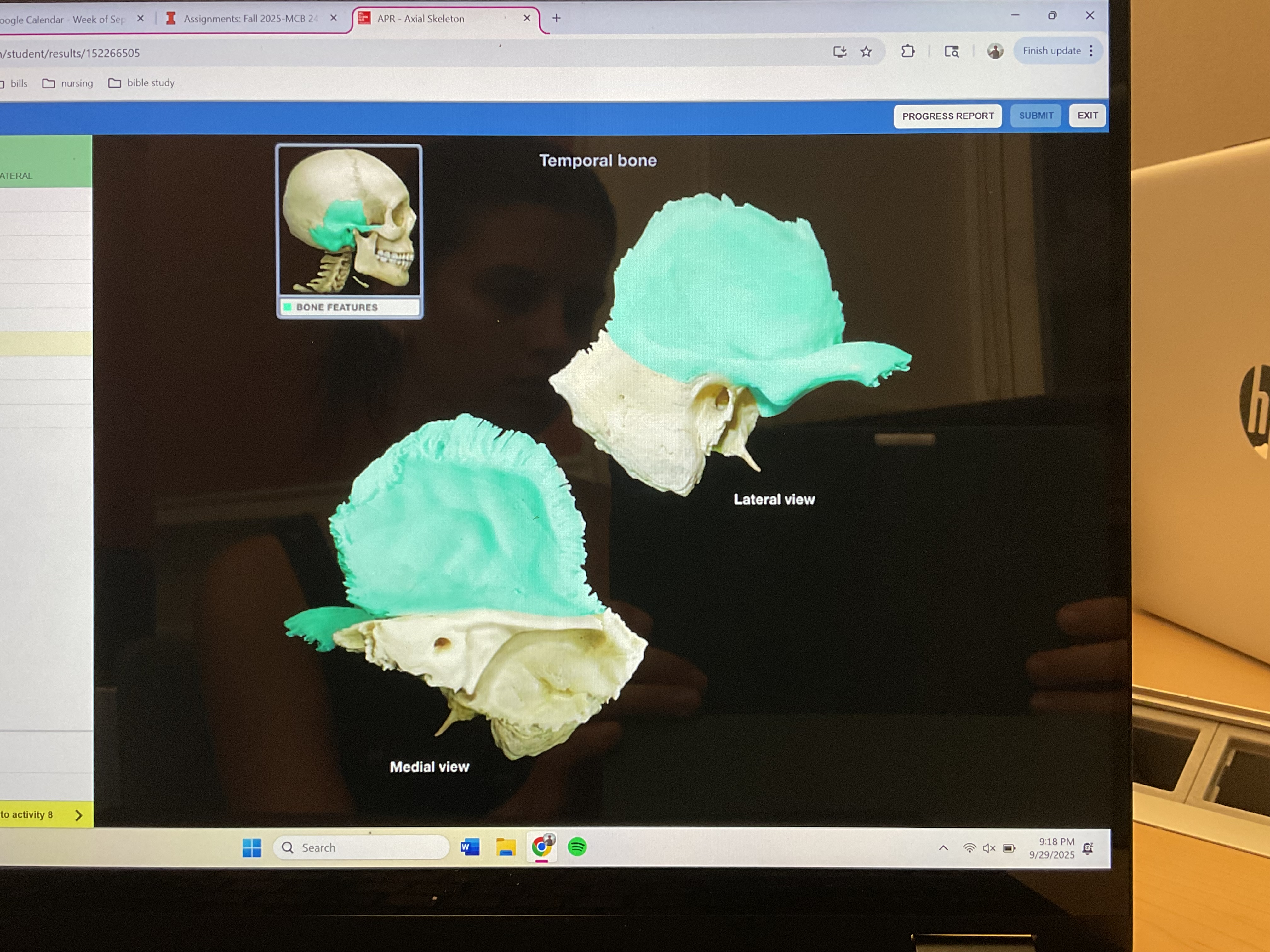 <p>Squamous part of temporal bone </p>