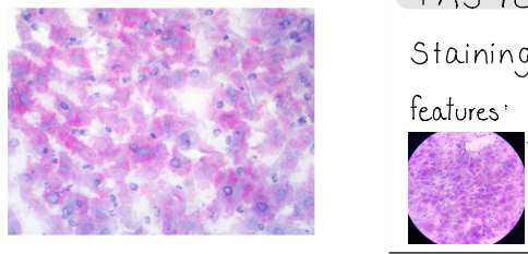 <p>Glycogen</p><p>PAS reaction</p><p>staining : PAS reagent</p><p>features : red granules equal in size, spread evenly throughout the cell, blue nucleus</p>
