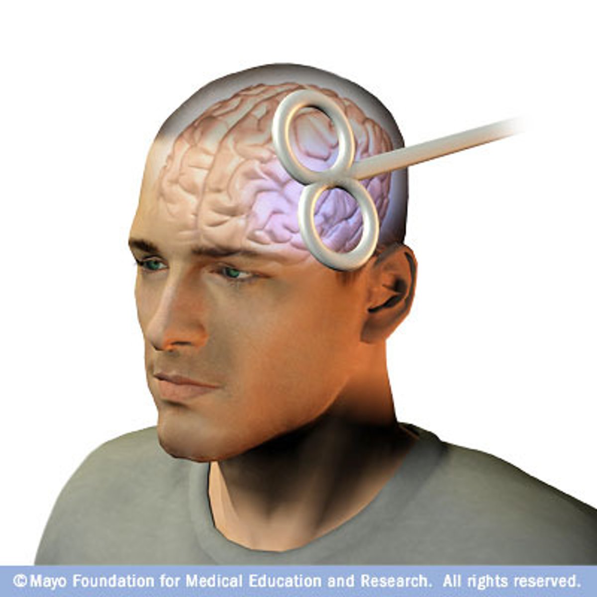 <p>a treatment that uses small electrical currents on the brain to change brain activity.</p>
