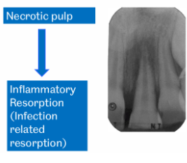 <p>Pulp death → toxins from pulp leach into PDL space → inflammatory response → inflammatory cells attempt to destroy debris but destory root in process</p><p>= inflammatory resorption aka infection related resorption</p><p>Can occur 2 weeks after injury</p>