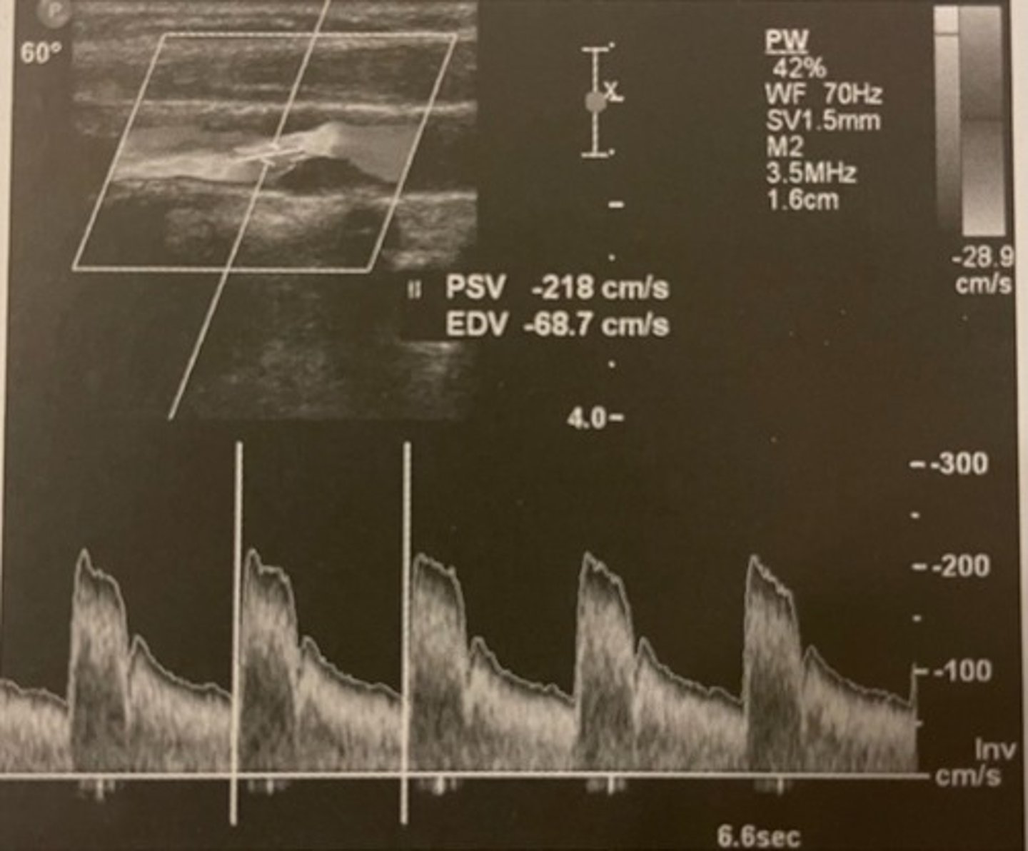 <p>In this example, the ICA velocities may underestimate the category of stenosis. Why?</p>