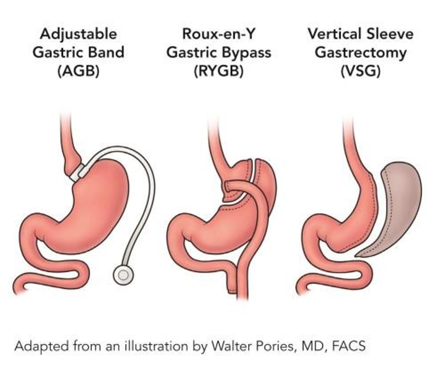 <p>gastric sleeve: creates a smaller stomach</p><p>gastric bypass: creates a pouch stomach + bypasses the duodenum</p>