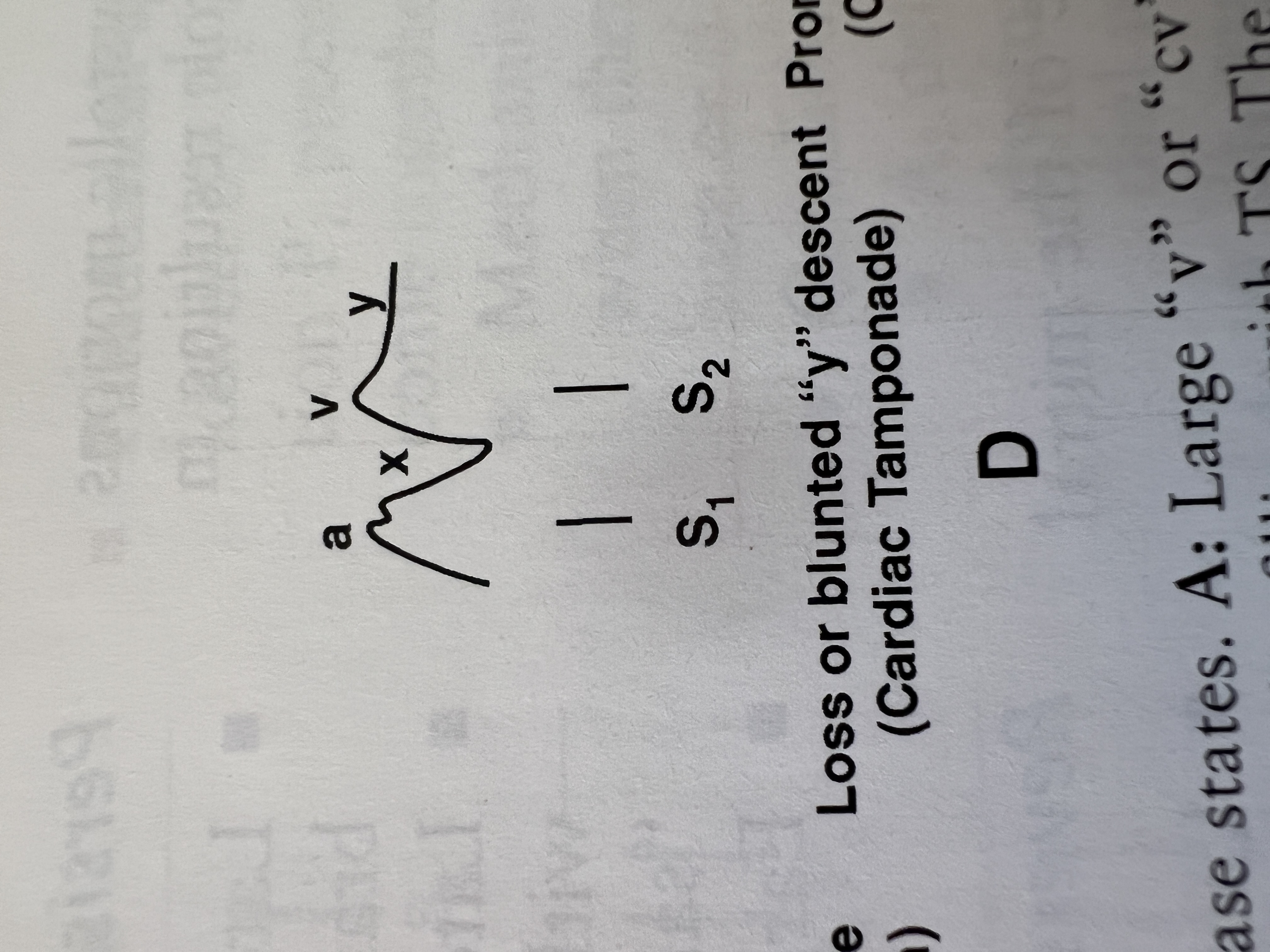 <p>What wave abnormalities are seen in cardiac tamponade?</p>
