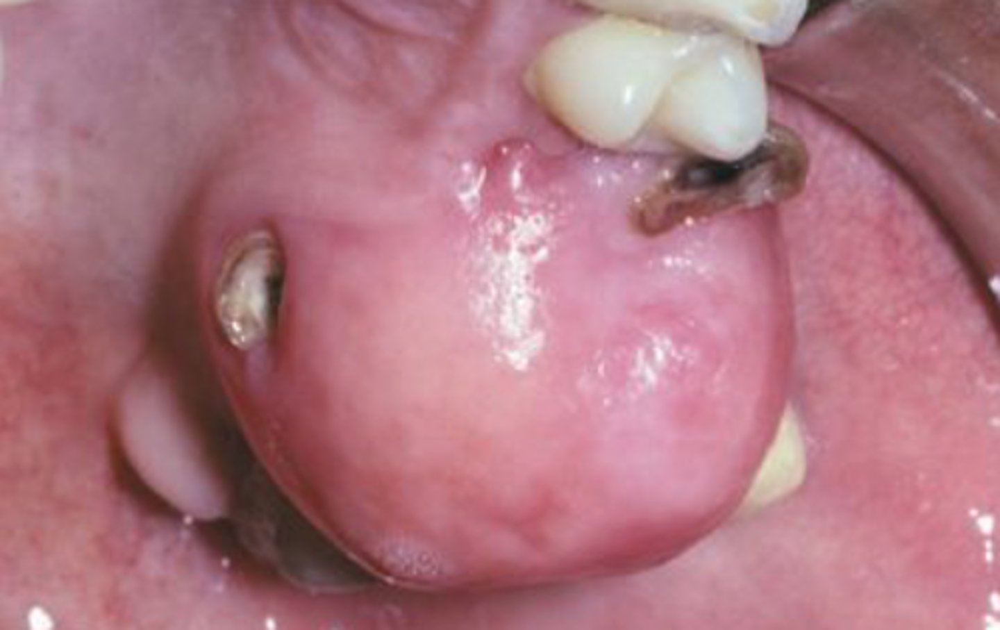 <p>• Occurs exclusively on the gingiva</p><p>• Nodular mass</p><p>• Frequently ulcerated</p><p>• Red to pink</p><p>• Seen most commonly in teens</p><p>and young adults</p>