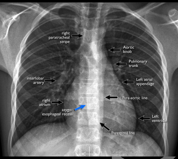 <ul><li><p>Derecha: Línea paratraqueal derecha, Hilio pulmonar derecho, Vena cava superior e inferior, Aurícula derecha, Ángulo cardiofrénico.</p></li><li><p>Izquierdo: Línea paratraqueal izquierda, Cayado aórtico, Hilio pulmonar izquierdo, Arteria pulmonar, Aurícula izquierda, Ventrículo Izquierdo, Diafragma .</p></li></ul><p></p>