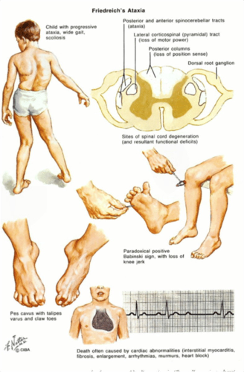 <p>Define Condition:</p><p>MOST COMMON SCA in YOUNG PEOPLE; Due to Autosomal recessive trinucleotide repeat disorder (GAA, frataxin gene). Leads to impairment in mitochondrial functioning &amp; destruction of myelin in Spinal Cord. </p><p>-Sx/PE: Ataxia/frequent falling, nystagmus, dysarthria, pes cavus, hammer toes, hypertrophic cardiomyopathy (Cause of death). Presents in childhood with kyphoscoliosis.</p>