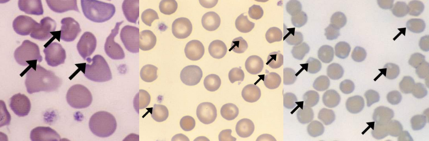 <p>A. Identify the cell<br>B. Identify the disease / condition<br>C. Composition of Inclusion</p>