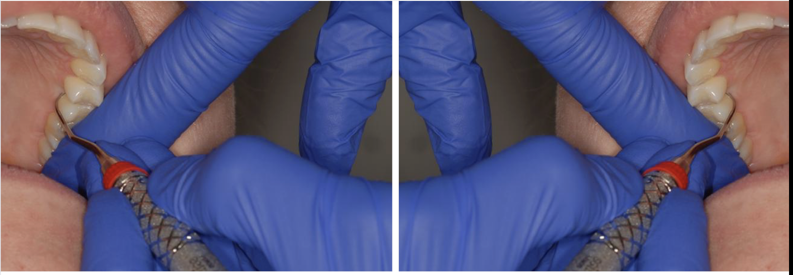 <p>what fulcrum is this </p>