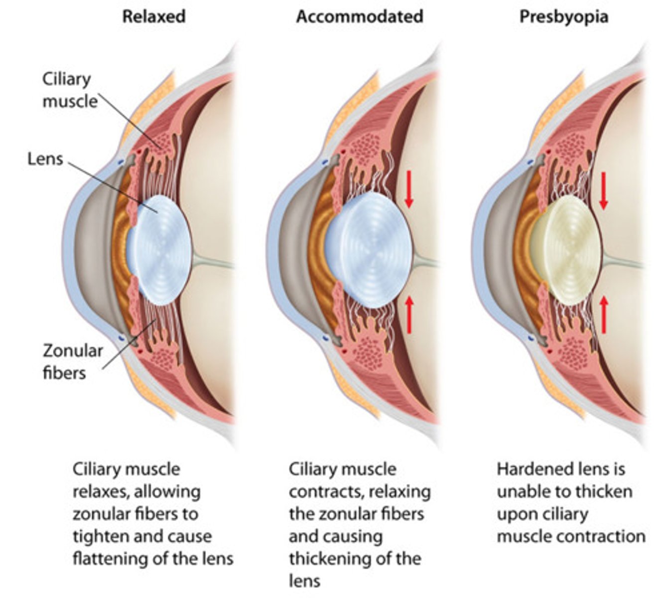 <p>Age-related loss of near vision due to a stiffening lens</p>