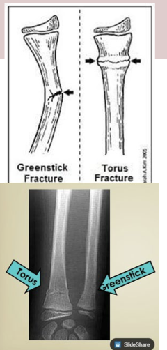 <p>Fracture does not transverse through the entire bone (bone is not broken into 2 pieces)</p><ol><li><p>Torus</p></li><li><p>Greenstick</p></li></ol><p></p>