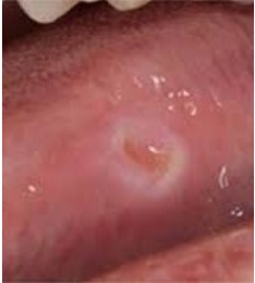 <p>What lesion is this?</p>
