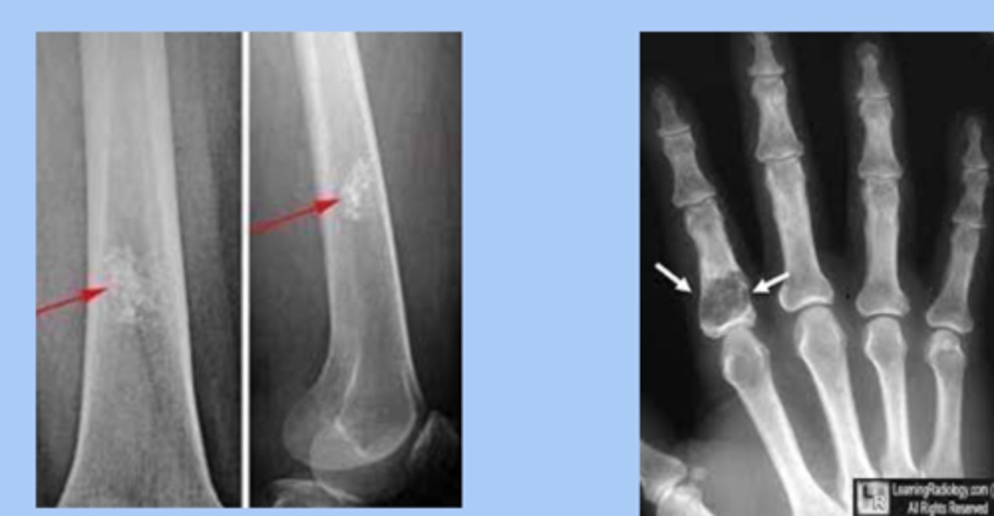 <p>-nest of benign cartilage within long bone </p><p>-silent lesion unless produces fracture </p><p>-dx: radiograph= fingernail through clay appearance </p><p>-tx: surgical curettage and bone grafting when indicated </p>