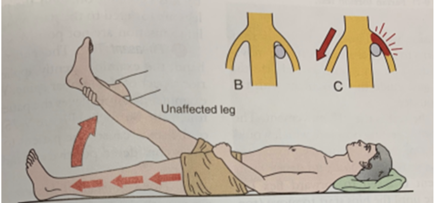 <p>Describe how to perform a crossed straight leg raise</p>