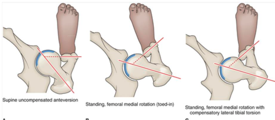 <p>-angle of torsion >15-20 degrees</p><p>-reduces hip joint stability</p><p>-more exposed anteriorly</p><p>-may lead to subsequent labral pathology</p><p>-to improve congruency → medial rotation of the femur </p><p>-alter knee biomechanics</p><p>-may lead to lateral tibial torsion</p><p>-hip ROM: increased medial rotation, decreased lateral rotation </p><p>-hip ER will be limited with hard end feel (DO NOT TRY AND STRETCH) </p>